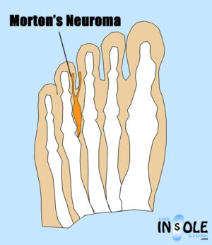 What is Morton's Neuroma? | Taking 10,000 Steps a Day With You